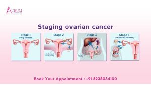 Ovarian Cancer Stages: Understanding Diagnosis and Treatment Options